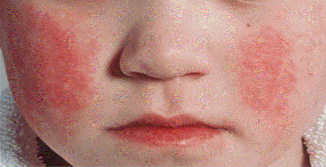 Уровень заболеваемости скарлатиной в Татарстане вырос в 4,2 раза