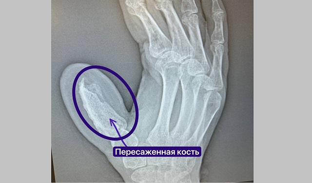 Новый палец на руке вырастили 57-летнему пациенту микрохирурги РКБ