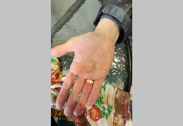 Спасатели помогли молодой маме из Казани снять кольцо с опухшего пальца