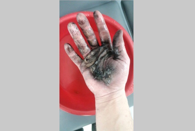 Татарстанда 24 яшьлек егетнең кулында электрон тәмәке шартлаган