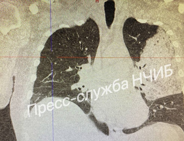 10 дней на ИВЛ: в Татарстане спасли 51-летнего мужчину с тяжелым поражением легких