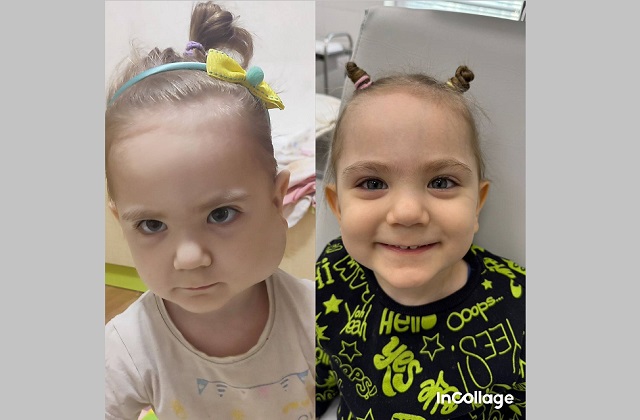 Боялась отражения в зеркале: в КДМЦ прооперировали ребенка с большой гемангиомой на лице