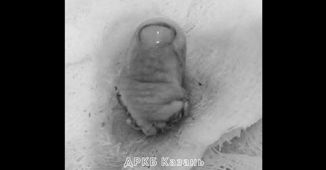 В Казани врачи ДРКБ пришили ребенку отрезанный пилой палец