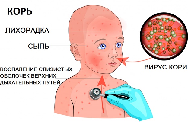 Жителям Татарстана рассказали, как распознать корь