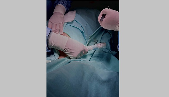 В Набережных Челнах онкологи внедрили новый метод диагностики «сторожевых» лимфоузлов 