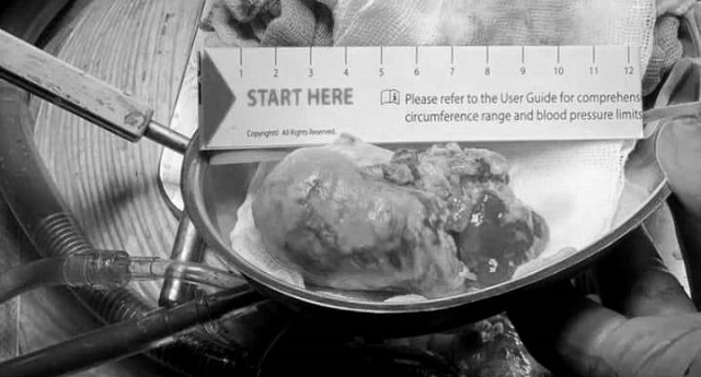 В Челнах врачи БСМП удалили редкую опухоль из сердца мужчины размером в 10 см