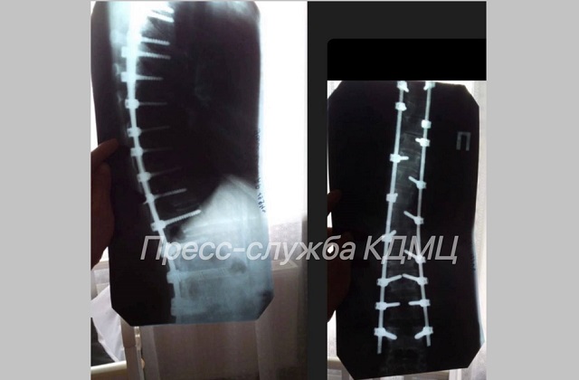 Когда обычная анестезия невозможна: в РТ врачи нашли решение для роженицы с металлоконструкцией 