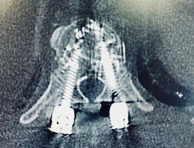 В Набережных Челнах врачи БСМП «зацементировали» пенсионеру позвоночник