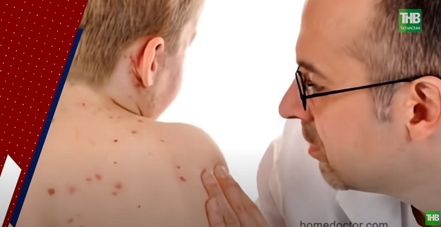 Крупный очаг кори в Татарстане: медики рассказали, чем грозит отказ родителей от вакцинации