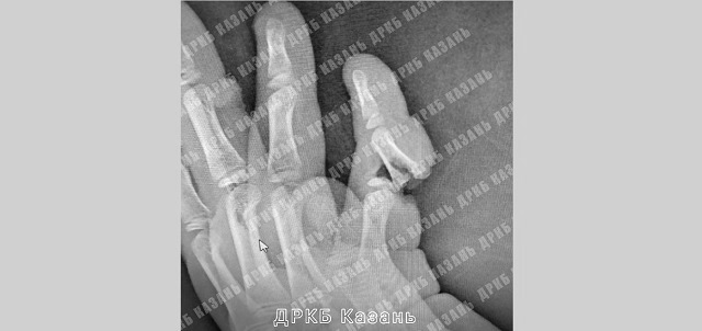 В Казани ребенку оторвало мизинец в результате несчастного случая 