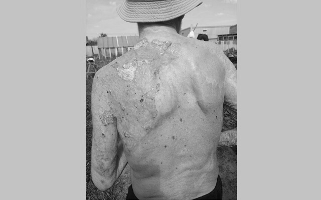 Ожог 3 степени, 18% тела и пересадка кожи: как в Мамадышской ЦРБ спасли 90-летнего пациента