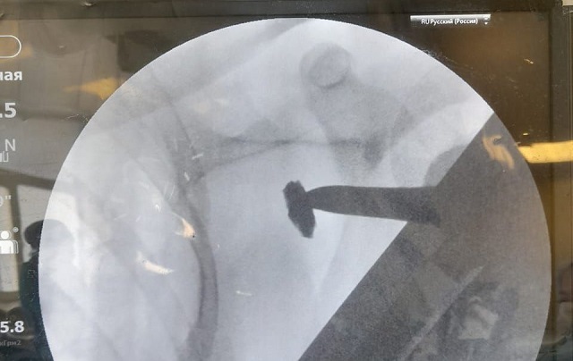 Ювелирную операцию по удалению осколка мины бойцу СВО выполнили врачи в Татарстане