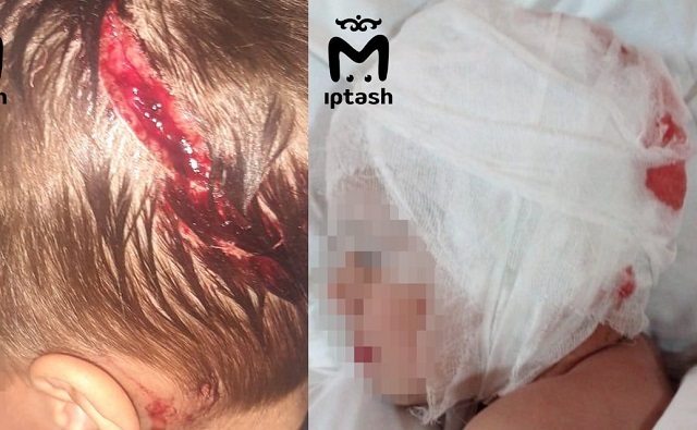 Минздрав РТ начал проверку из-за отказа в помощи покусанному собакой ребенку