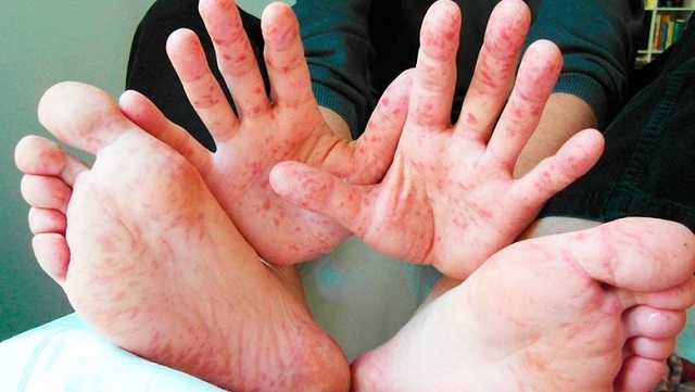 13 случаев кори зарегистрировали в Татарстане за два месяца