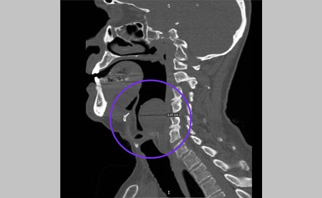 Редкий случай: в Татарстане врачи удалили пациенту огромную миксому гортани