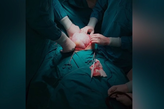 Жительницу Набережных Челнов экстренно прооперировали из-за быстрорастущего живота