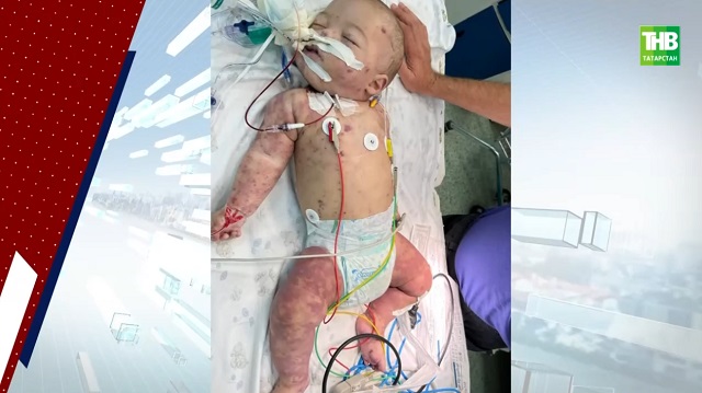 Татарстан табибларының могҗизага тиң гамәле: 5 айлык сабыйның гомере өчен 3 ай буе көрәшкәннәр