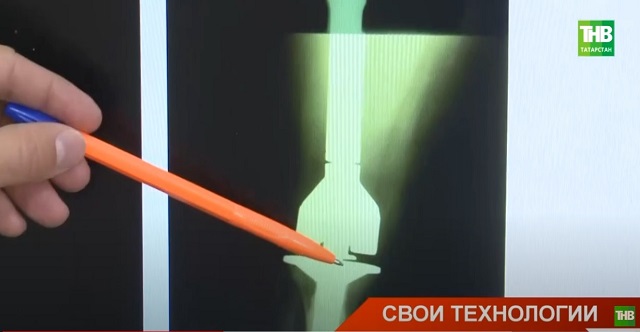 В Казани начали применять отечественные импланты в операции по замене пораженной раком кости