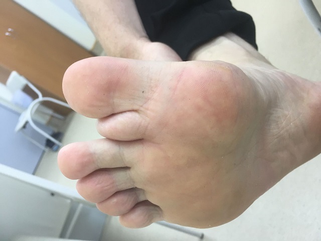 В Нижнекамске хирург удалил мужчине «шестой палец»