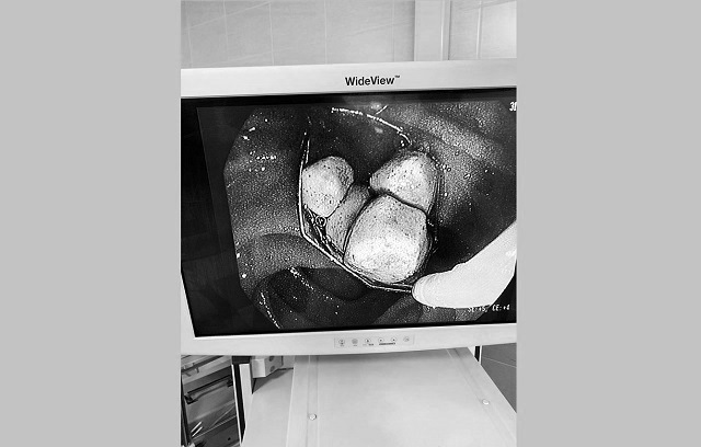 В Татарстане врачи БСПМ рассказали о спасении пациентки с опасной патологией