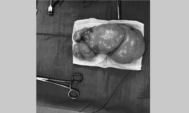 В Казани микрохирурги РКБ избавили 66-летнюю пациентку от огромной липомы