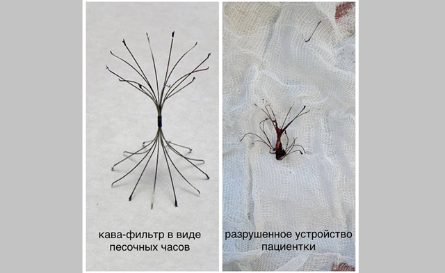 Врачи БСМП извлекли из легких пациентки кава-фильтр, разломившийся на семь частей