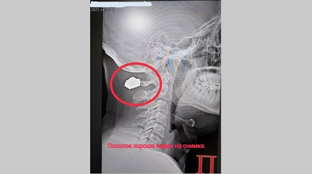 Нейрохирург Нижнекамской ЦРБ достал осколок мины из шеи бойца СВО