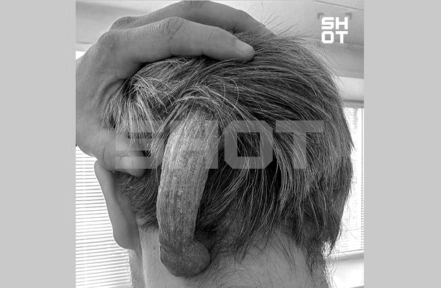 Гигантский «дьявольский рог» удалили 30-летнему пациенту врачи в Набережных Челнах
