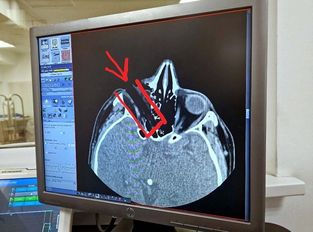 В Татарстане врачи спасли рыбака с вошедшим в глаз 7-сантиметровым сучком