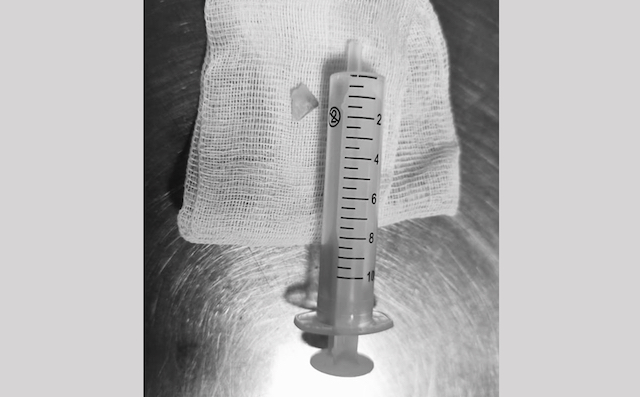 Подавившуюся квашеной капустой 76-летнюю женщину спасли врачи Татарстана