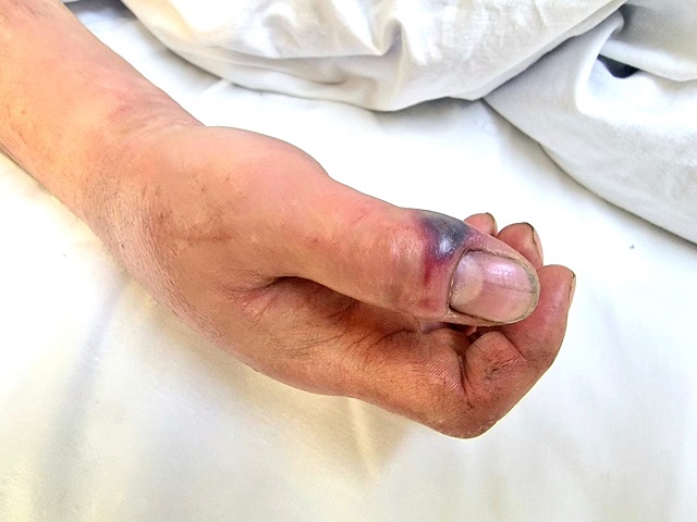 Врачи Набережных Челнов спасли руку мужчины от ампутации после укуса «юной» гадюки