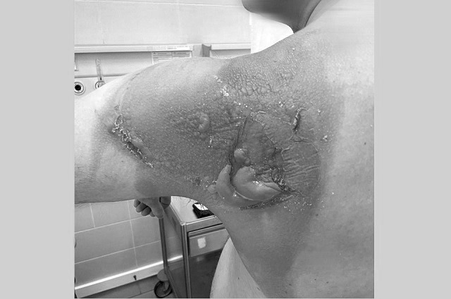 РКБ: химический ожог получил казанец от капсул для стирки белья с маркетплейса