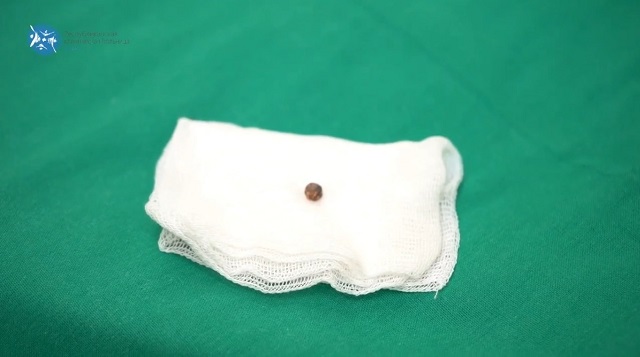 Впервые в Татарстане врачи извлекли осколок из бьющегося сердца бойца СВО