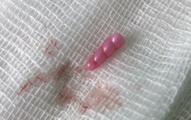 Прожившего два года с рогом единорога во лбу ребенка прооперировали в Подмосковье