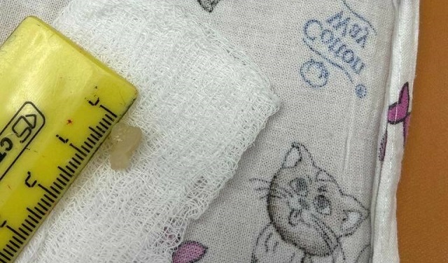 Подавившегося куском капусты ребенка спасли врачи из казанской ДРКБ в Нижнекамске