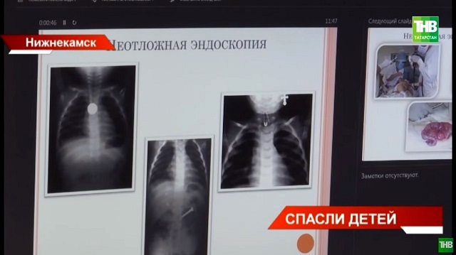 Хирурги Нижнекамска рассказали о спасении жизней детей, проглотивших опасные предметы