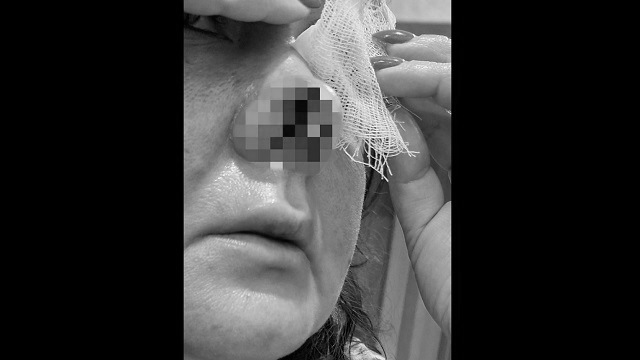 Погладившая чужую собаку 39-летняя воспитательница из Татарстана лишилась носа