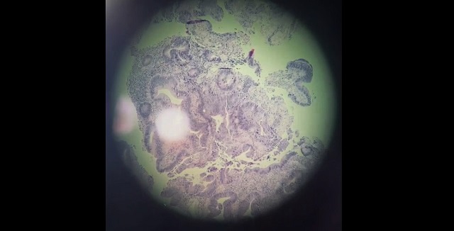 «Как история вселенной Marvel»: онкологи РТ показали, как выглядит раковая клетка 