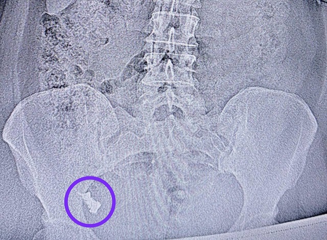 Проглотившую зубной протез 50-летнюю женщину спасли врачи РКБ в Казани