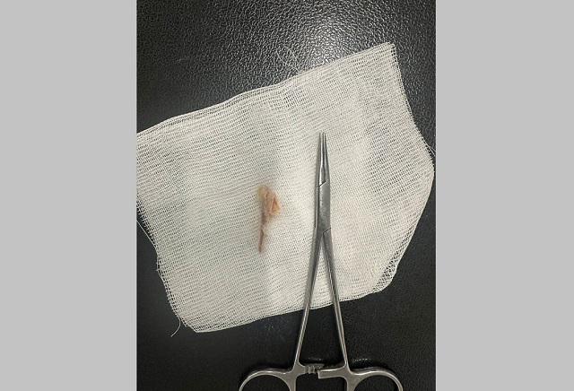 Двум татарстанцам провели операции по удалению костей из пищевода