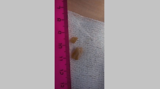 В Казани врачи ДРКБ спасли подавившегося осколком ореха годовалого ребенка – видео