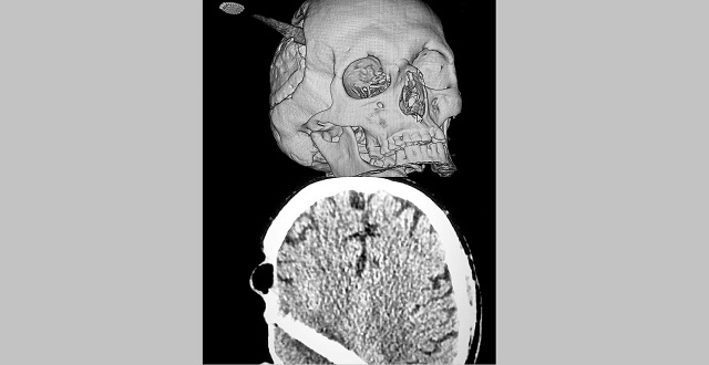 В Казани врачи РКБ врачи достали из головы мужчины воткнутую зубную щетку