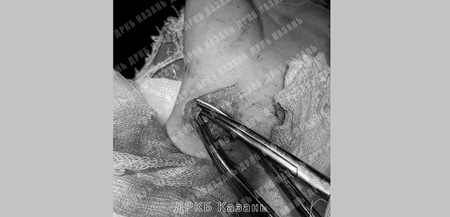 В Казани врачи ДРКБ прооперировали порезавшегося осколками бутылки ребенка