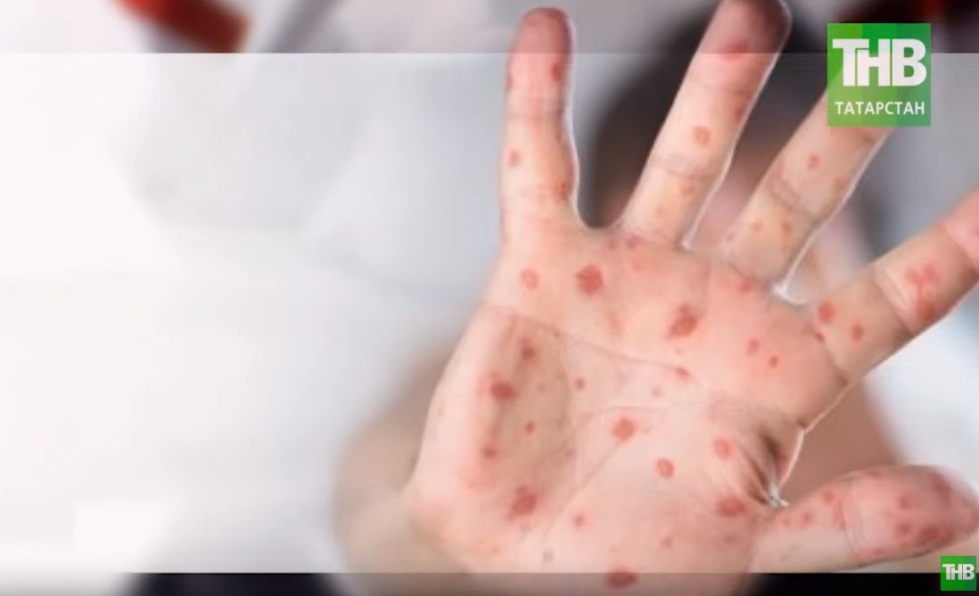 Назван источник вспышки кори в Татарстане (ВИДЕО)
