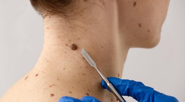 В Татарстане проверкой кожи на онкообразования займется искусственный интеллект