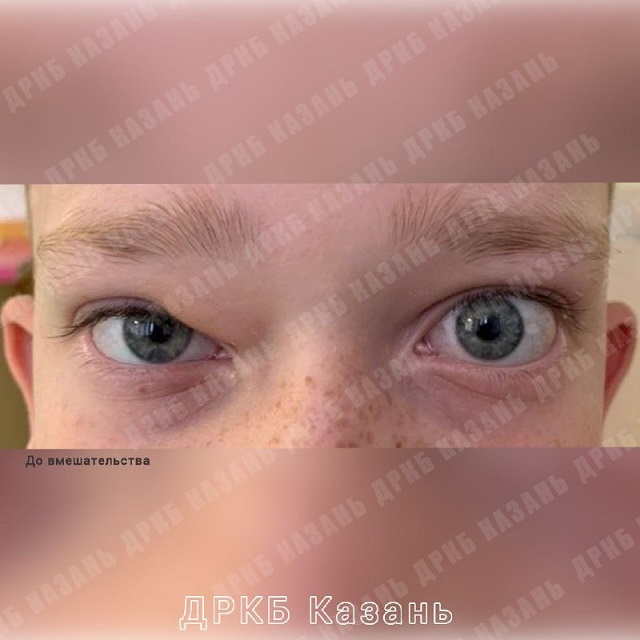 В Казани врачи ДРКБ рассказали о проведении операции по удалению кисты над веком 