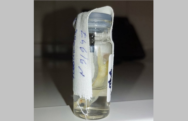 Врачи РКБ спасли двух пациенток с застрявшими в горле большими рыбными костями