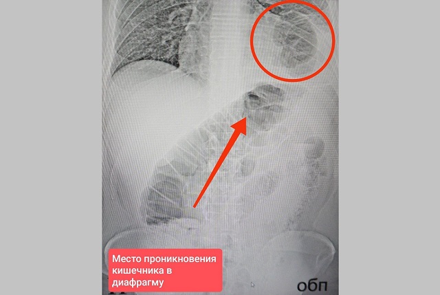 Кишка в груди: в Татарстане врачи спасли 46-летнего пациента с необычной грыжей
