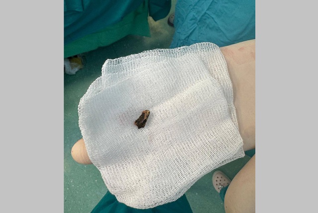 Мог проткнуть вену в любой момент: врачи Татарстана извлекли осколок из печени бойца СВО