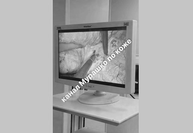 Пациентку с редким синдромом Рейно спасли врачи в Татарстане